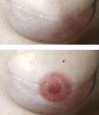 Resultado areola 1