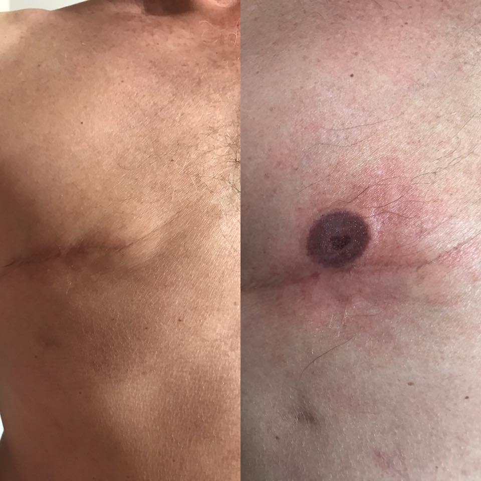 Resultado areola 2